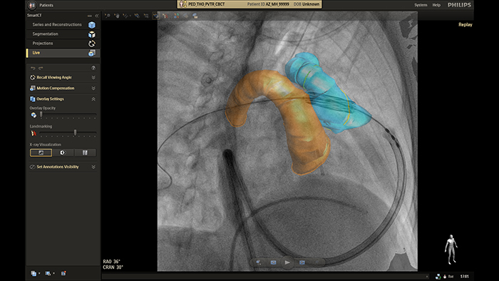 Orienta&ccedil;&atilde;o em tempo real do SmartCT