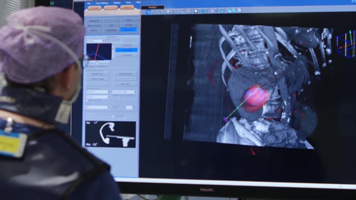 Ablação e biopsia tumoral